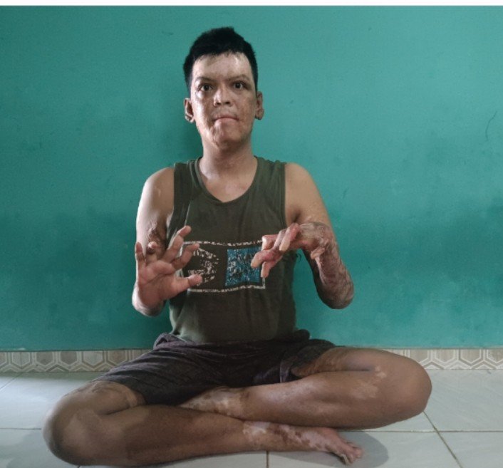 Memprihatinkan, Khusein Warga Menarin Butuh Bantuan