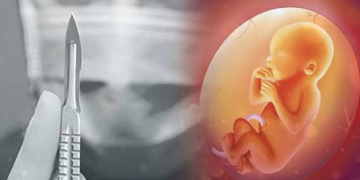 Keterangan foto: Aborsi. (Ilustrasi/Internet/Istimewa)