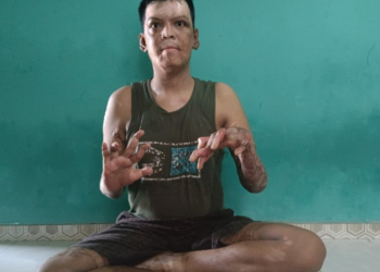 Khusein Rifai warga Menarin Kecamatan Mentebah sudah dua tahun alami luka bakar dan belum sembuh