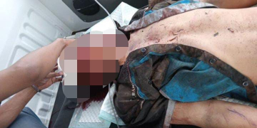 Rahul warga Desa Bekuan Kecamatan Seberuang saat dilarikan ke klinik